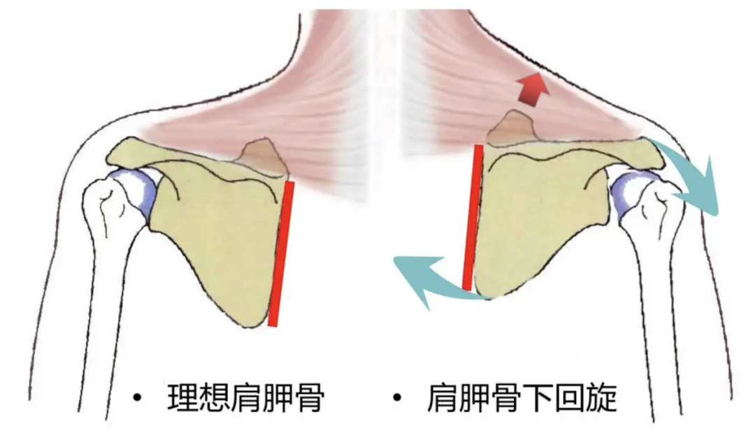 甚至可能是一种病态 —— 医学上称之为肩胛骨下回旋综合征