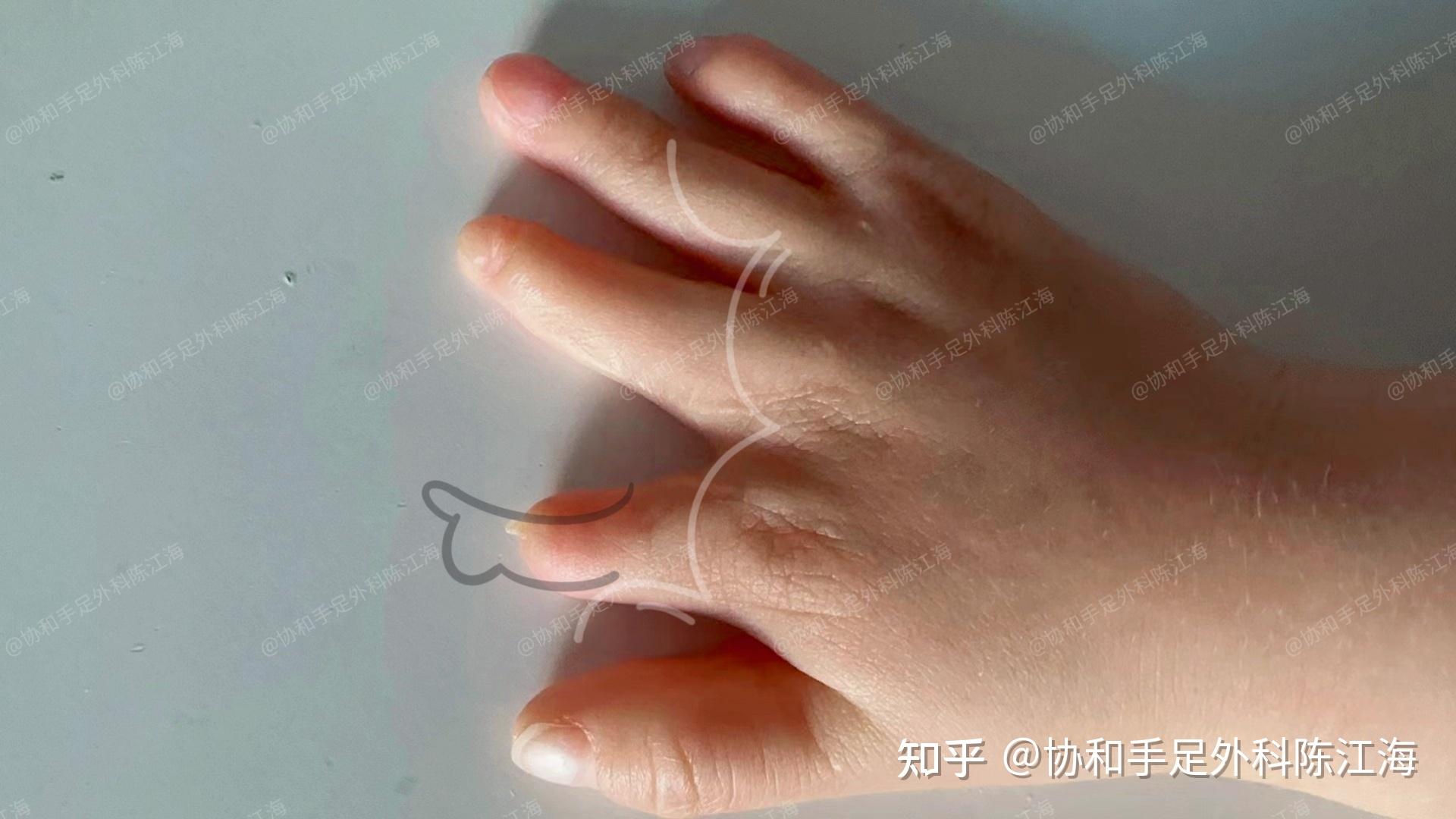 并指畸形可以分为哪些类型?分指一定要植皮吗?听听医生怎么说 - 知乎
