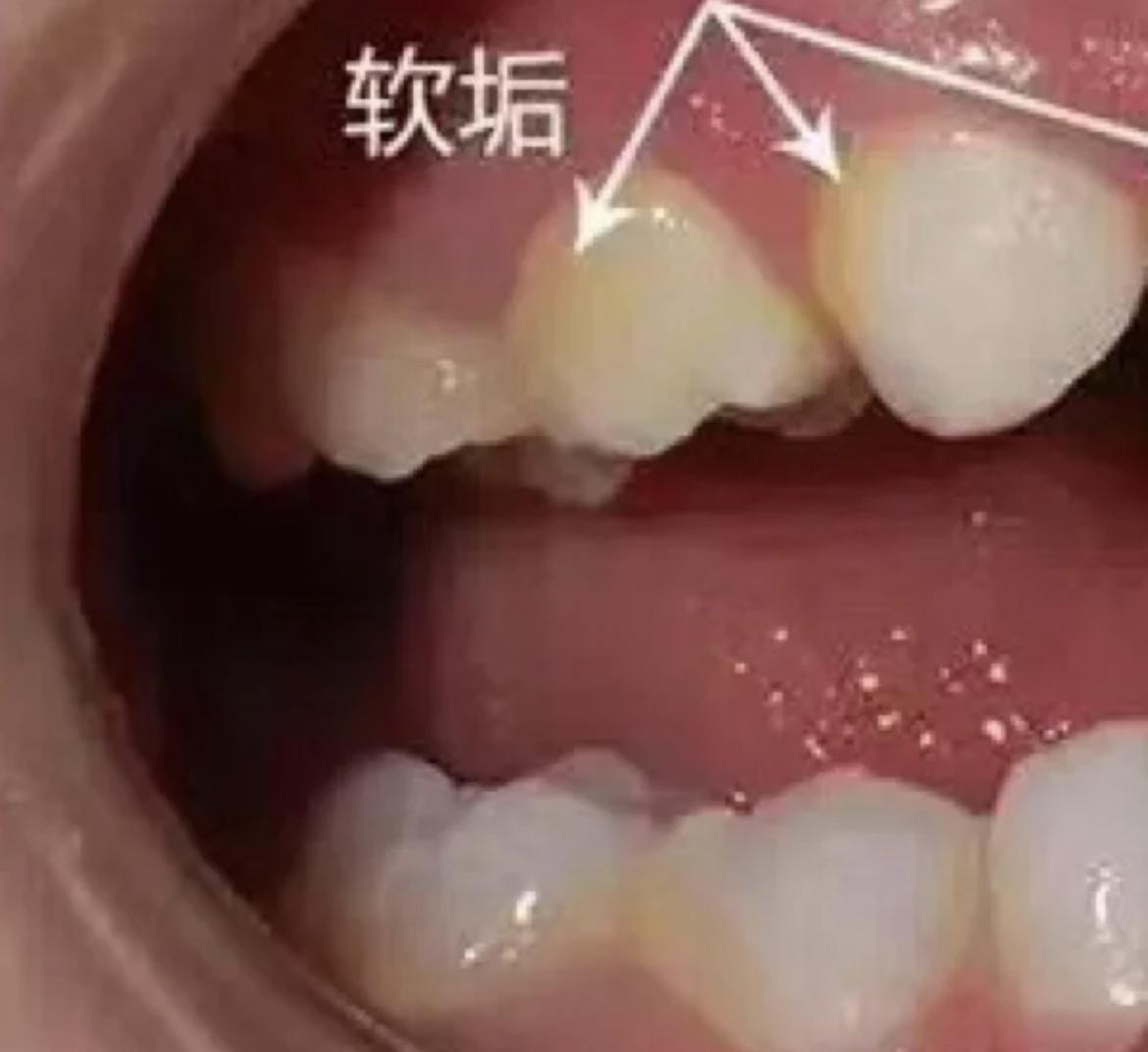牙黄有什么方法变白一点？ - 知乎