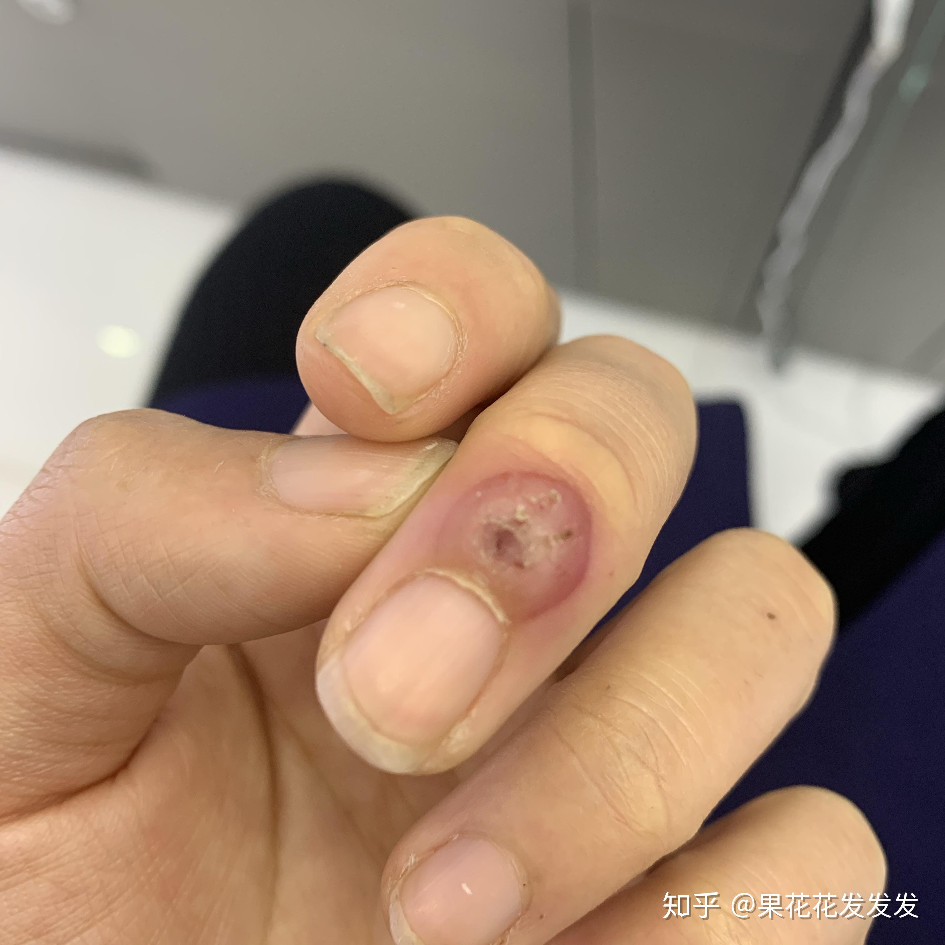 开个帖子记录冷冻休子的过程126