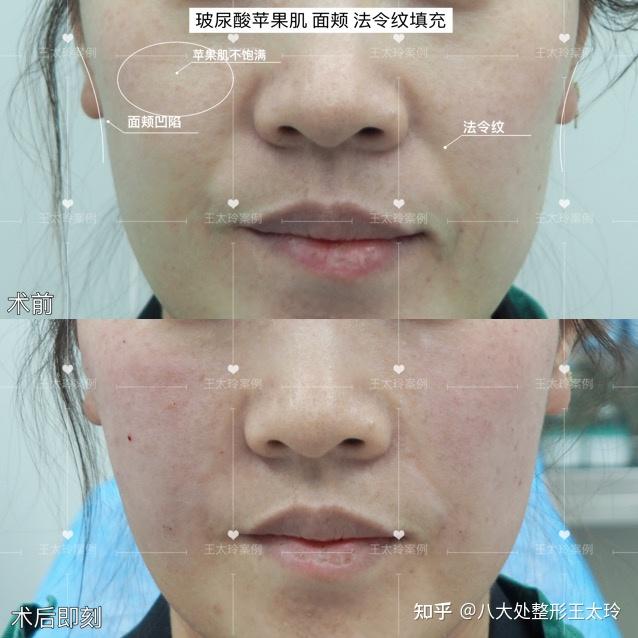 玻尿酸苹果肌，法令纹，面颊填充案例分享 - 知乎