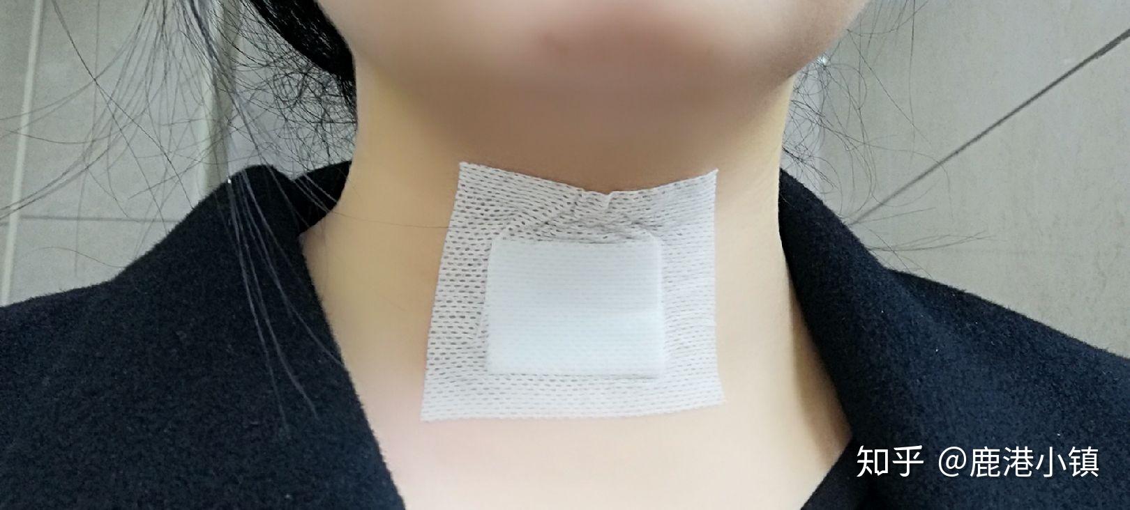 甲状腺穿刺活检注意事项