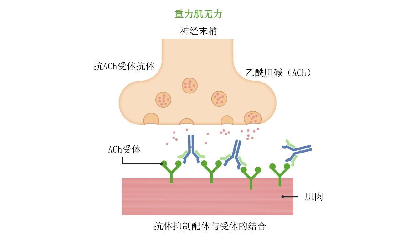 首個全身型重症肌無力長效c5補體抑制劑ultomirisravulizumabcwvz於