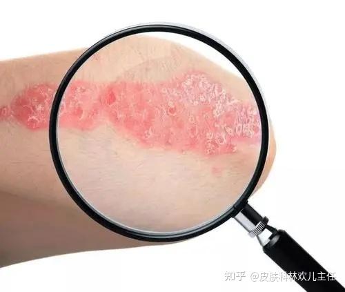 什么叫湿疹 zhuanlan.zhihu.com