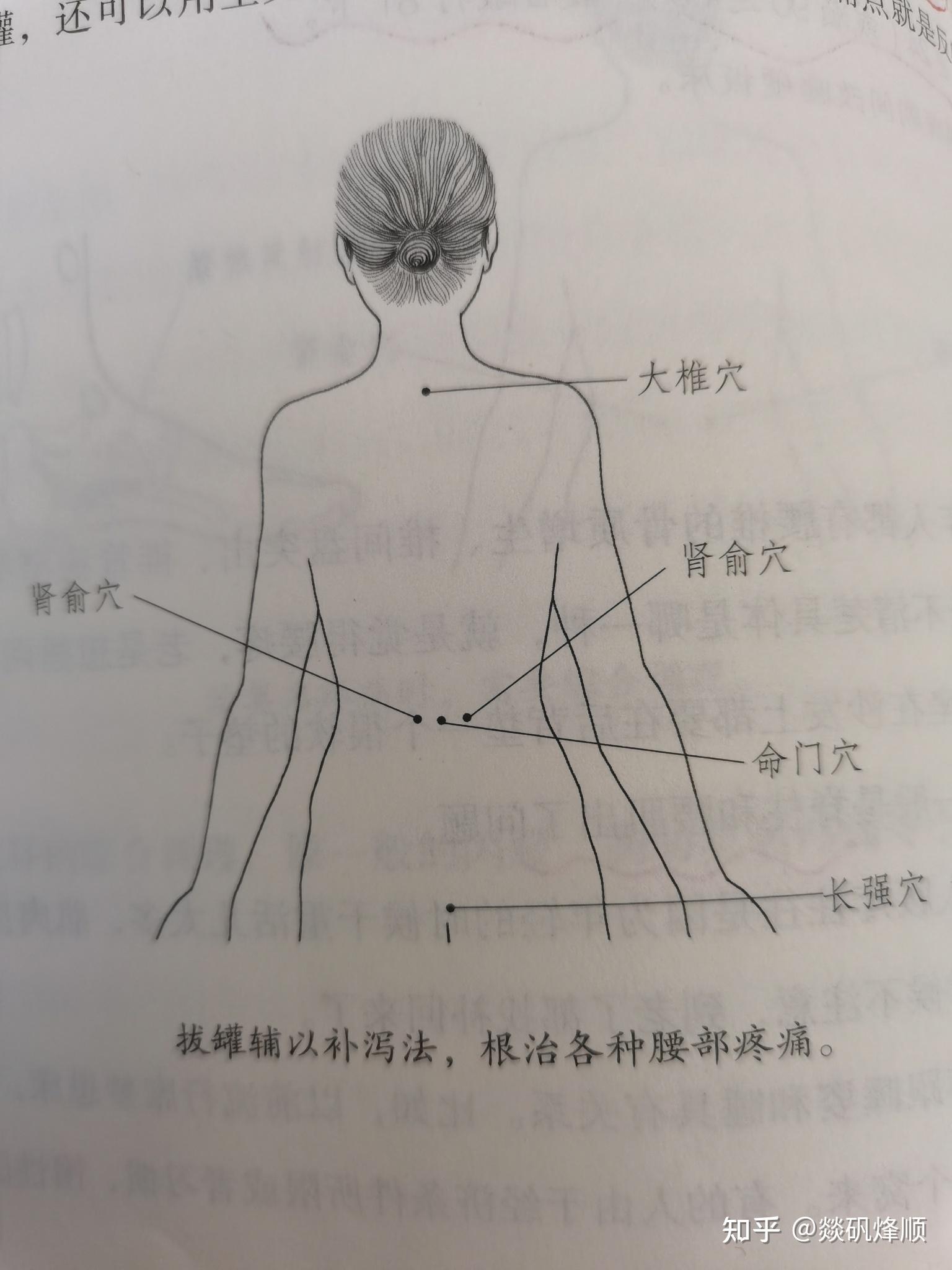 腰疼 在命门和肾俞拔罐;沿着脊柱两侧拔罐