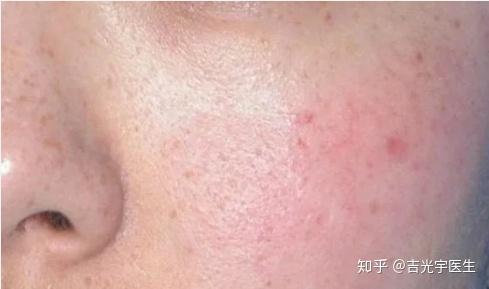 做完激光感觉自己角质层变薄了皮肤是不是就是敏感肌了