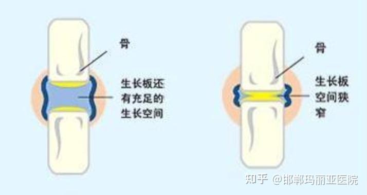 如何判断孩子骨骺线是否闭合？家长们要时刻注意！ - 知乎