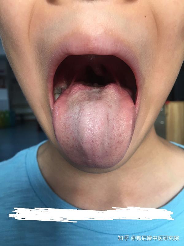 鼻甲腺样体肥大上颌窦炎全都有