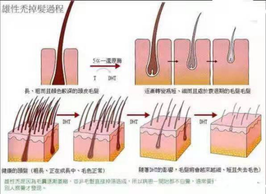 秃顶怎么办,如何生发? - 知乎