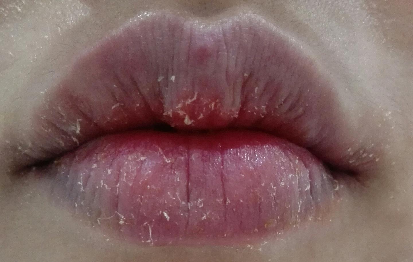嘴巴長水泡？唇皰疹會傳染嗎？一次搞懂唇皰疹的原因與治療 - Hello 醫師