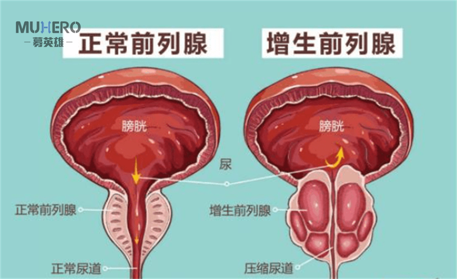 男性前列腺位于膀胱下方,处在盆腔的最底部,是男性呈坐位时位置最低的