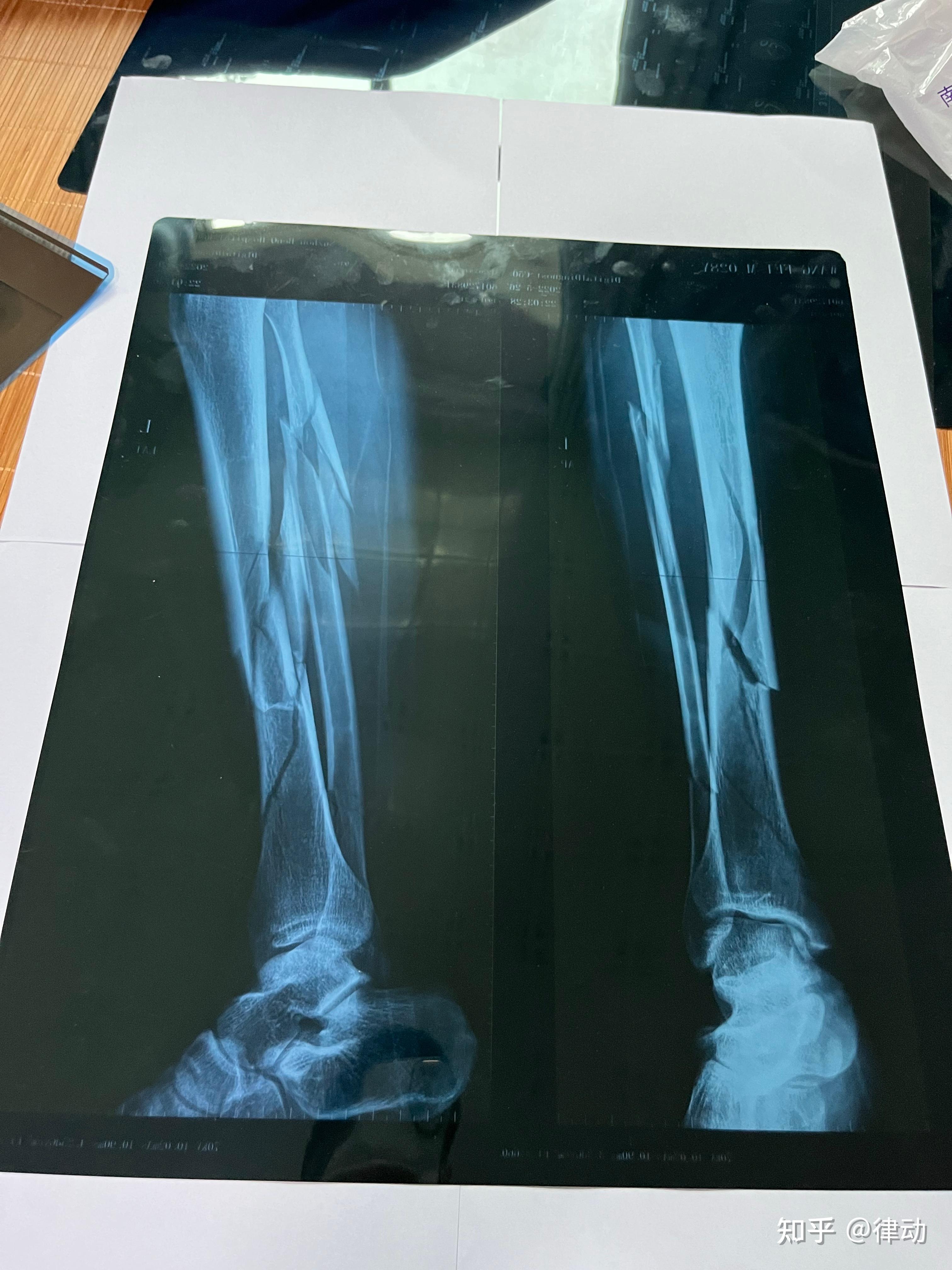 左小腿胫腓骨粉碎性骨折整个历程记录 