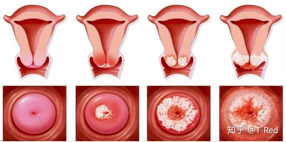 生殖道惡性腫瘤,主要以鱗狀上皮細胞癌為主,約佔90%,其餘為宮頸腺癌