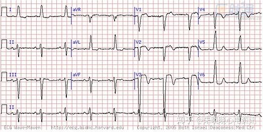 例如左束支傳導阻滯(lbbb)提示心肌缺血,但通常不包括在心梗的診斷