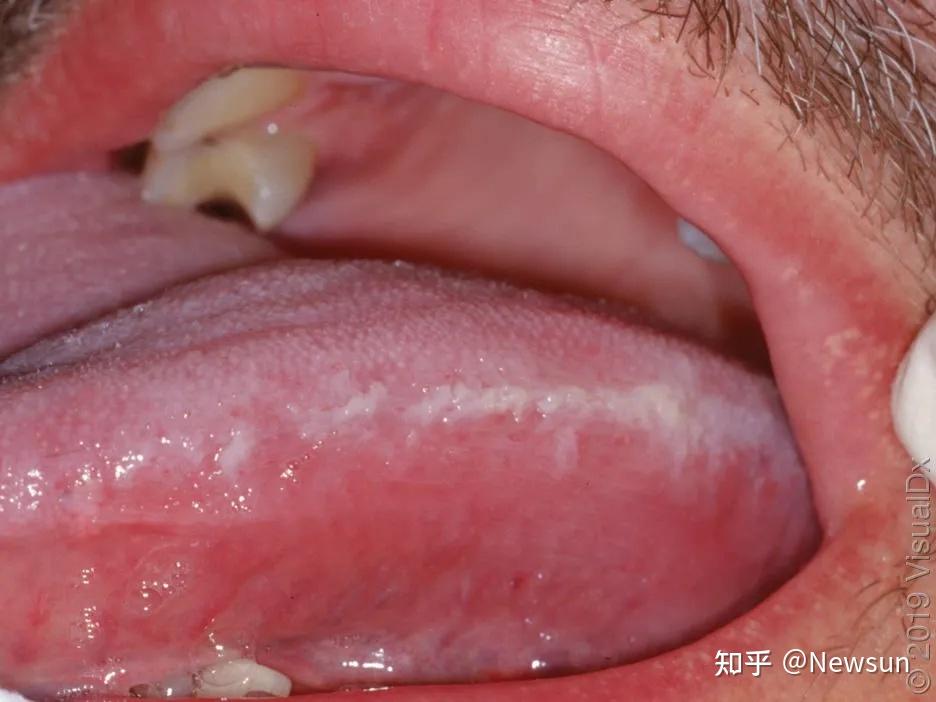 发现嘴巴里面有白斑，是得了什么病？（附图片） - 知乎