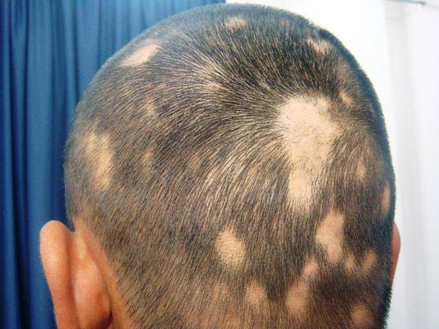 图片来源网络如何辨别:脱发性毛囊炎的初期症状比较典型,毛囊周围会