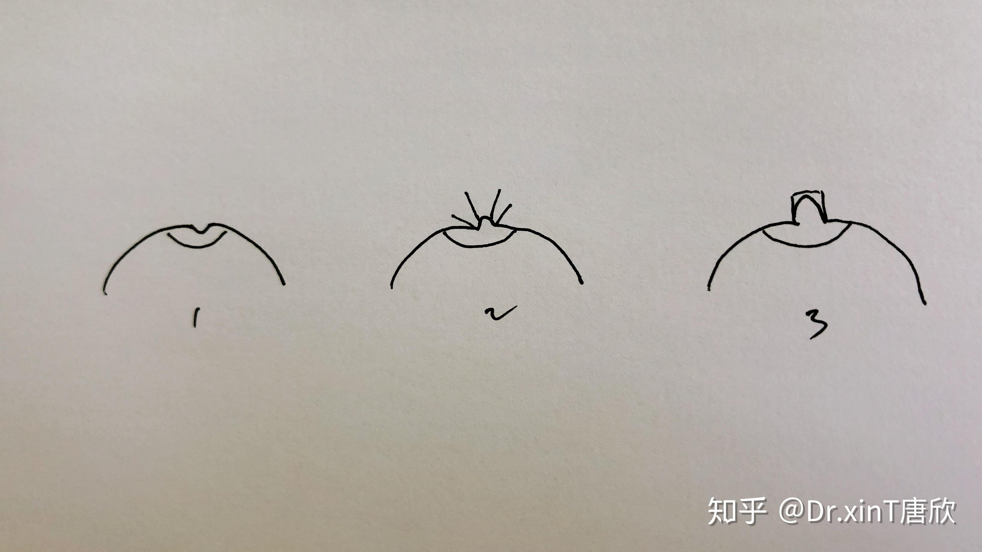 不破坏乳腺导管,可以保留哺乳功能,同时也不会影响乳头的感觉,并且