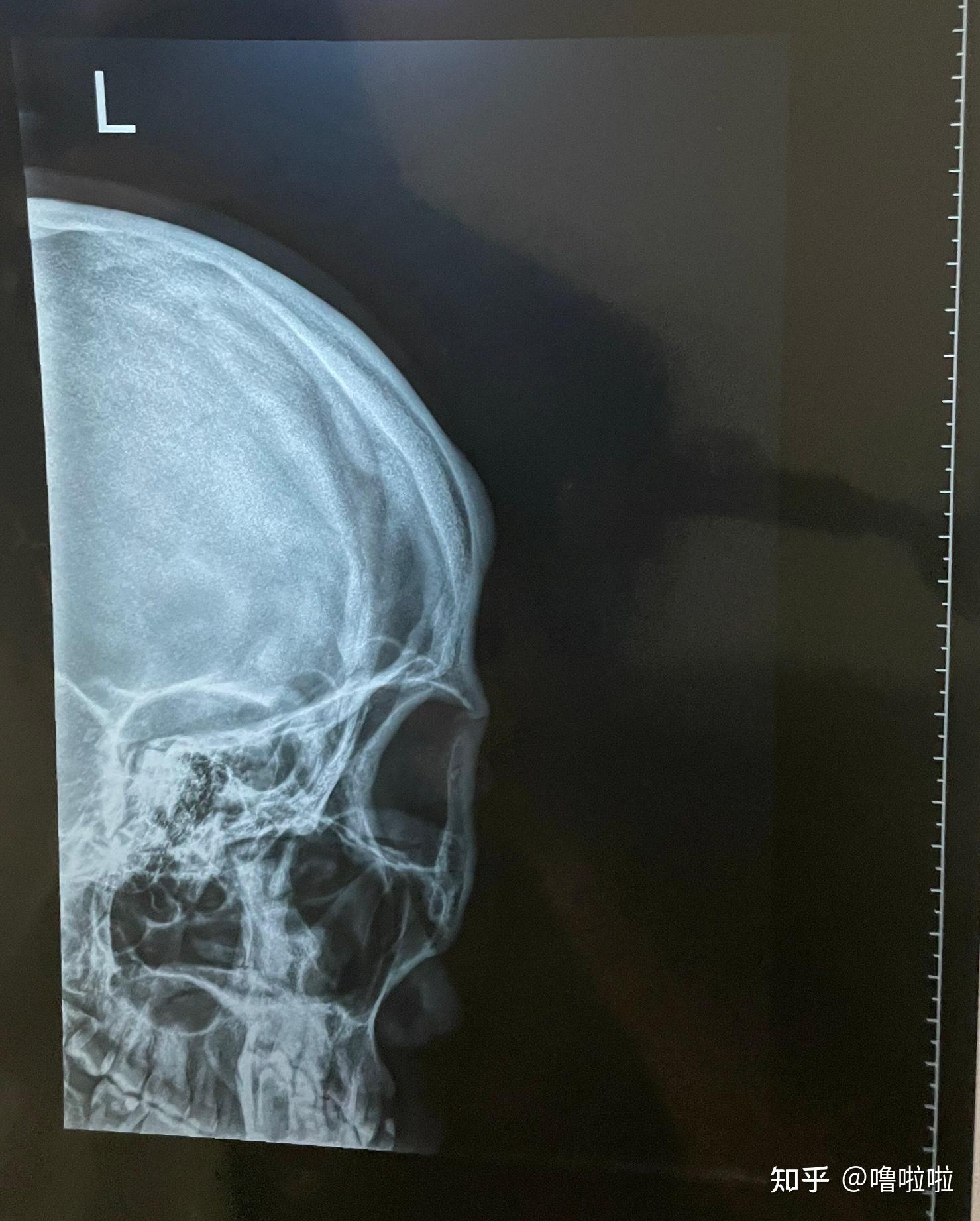 颅骨良性骨瘤日间手术记录