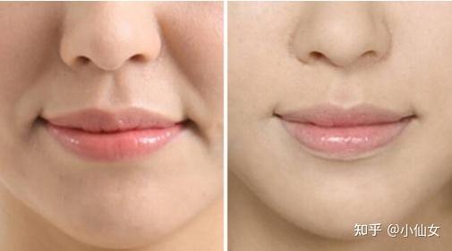 怎么样减少法令纹 v2-680ed572799b0aa3f4b3c7a2d1e607e7_r.jpg