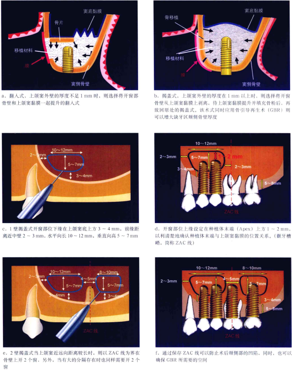【理论合集】上颌窦底提升术的成功率、术式选择标准、提升限度、分类,都给你理清楚! - 知乎