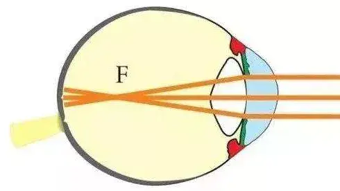 3分鐘科普丨為什麼近視不可逆眼軸長度告訴你
