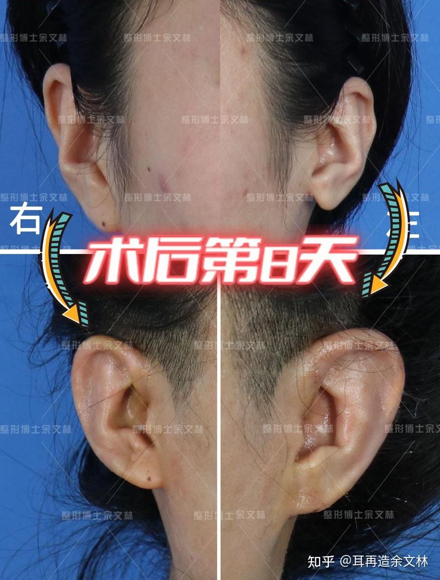 耳朵反骨是什么样子的图片