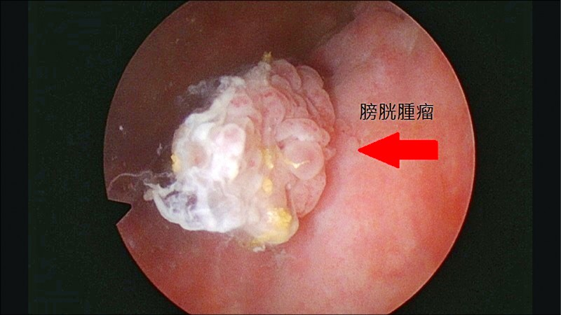 55岁膀胱癌多处转移还腹腔积液,抗癌5年多亏了新疗法治愈