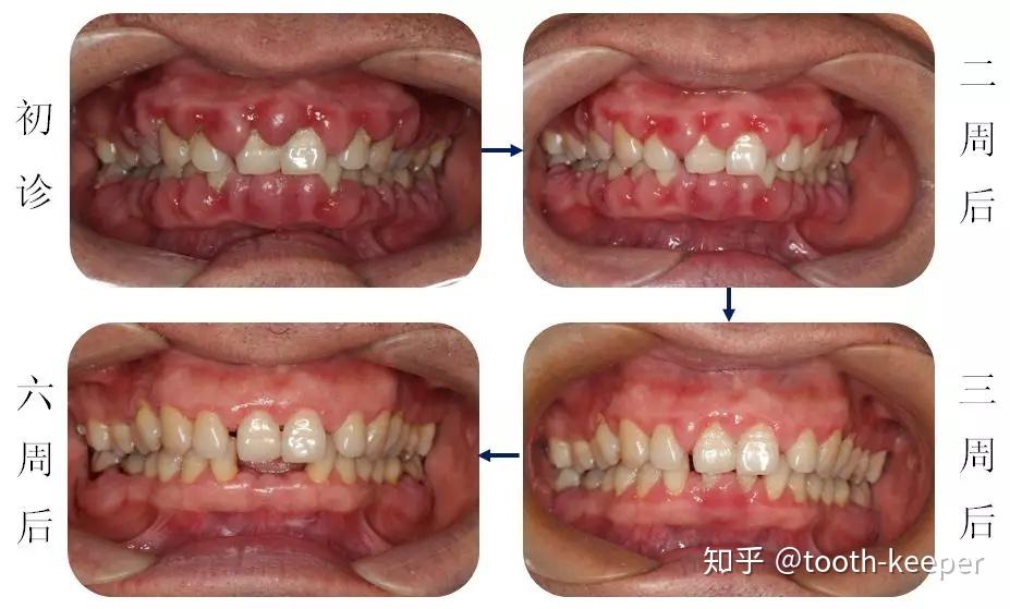 药物性牙龈肥大序列治疗一例 - 知乎