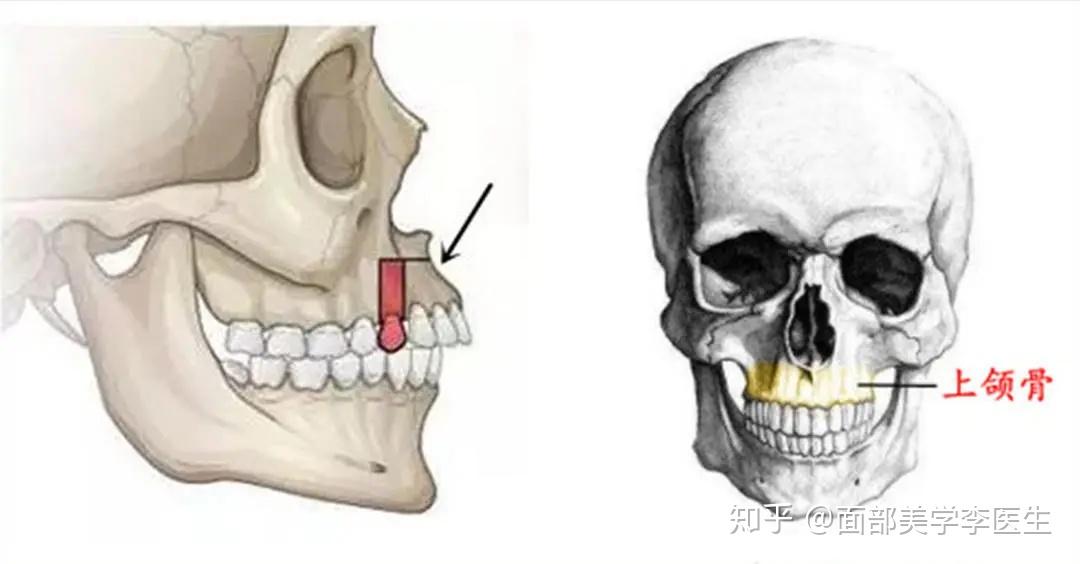 上颌骨颧突图片