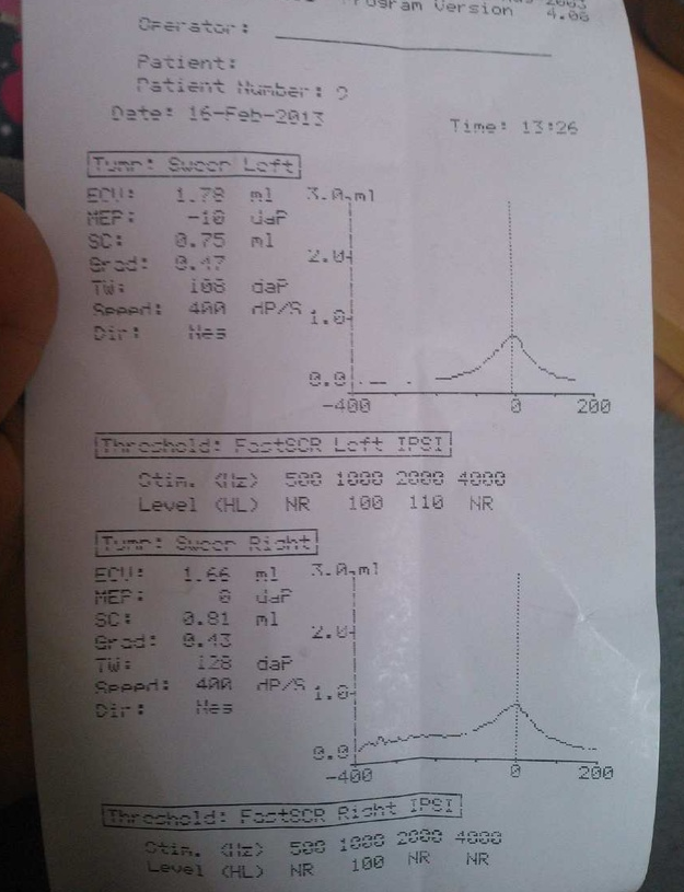 小儿听力筛查声导抗检查报告怎么看? - 知乎