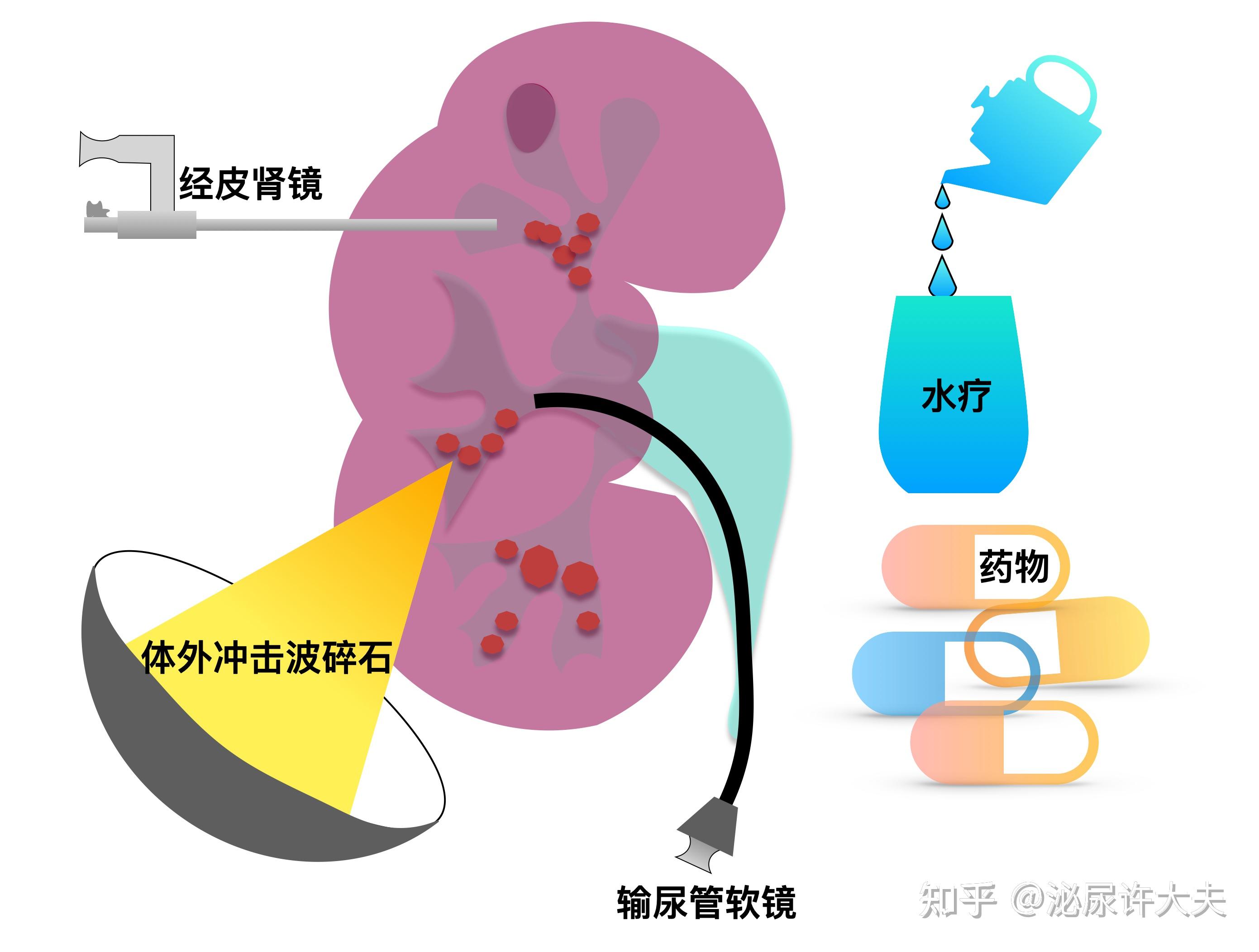 肾结石有哪些治疗方法? - 知乎