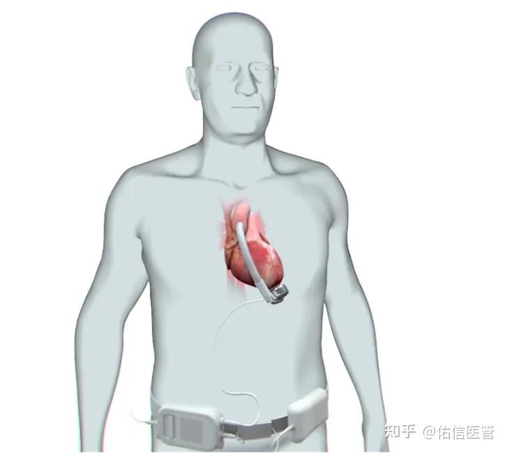 Corwave 全球首植!基于独特波浪膜技术的左心室辅助装置 - 知乎