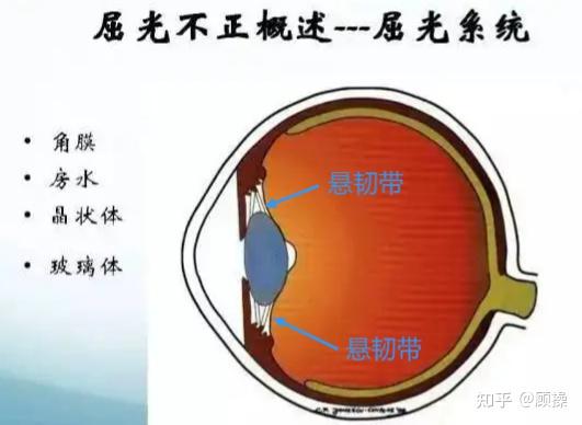 什麼是晶狀體脫位