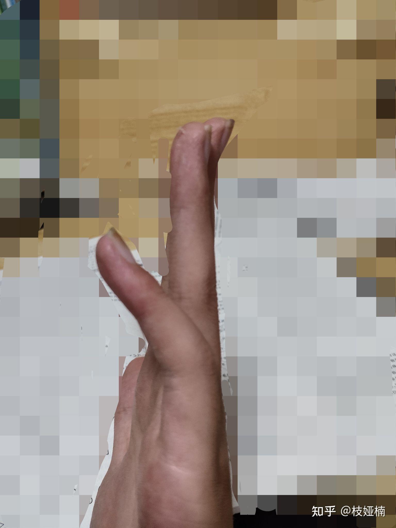 手指脱臼的症状图片图片