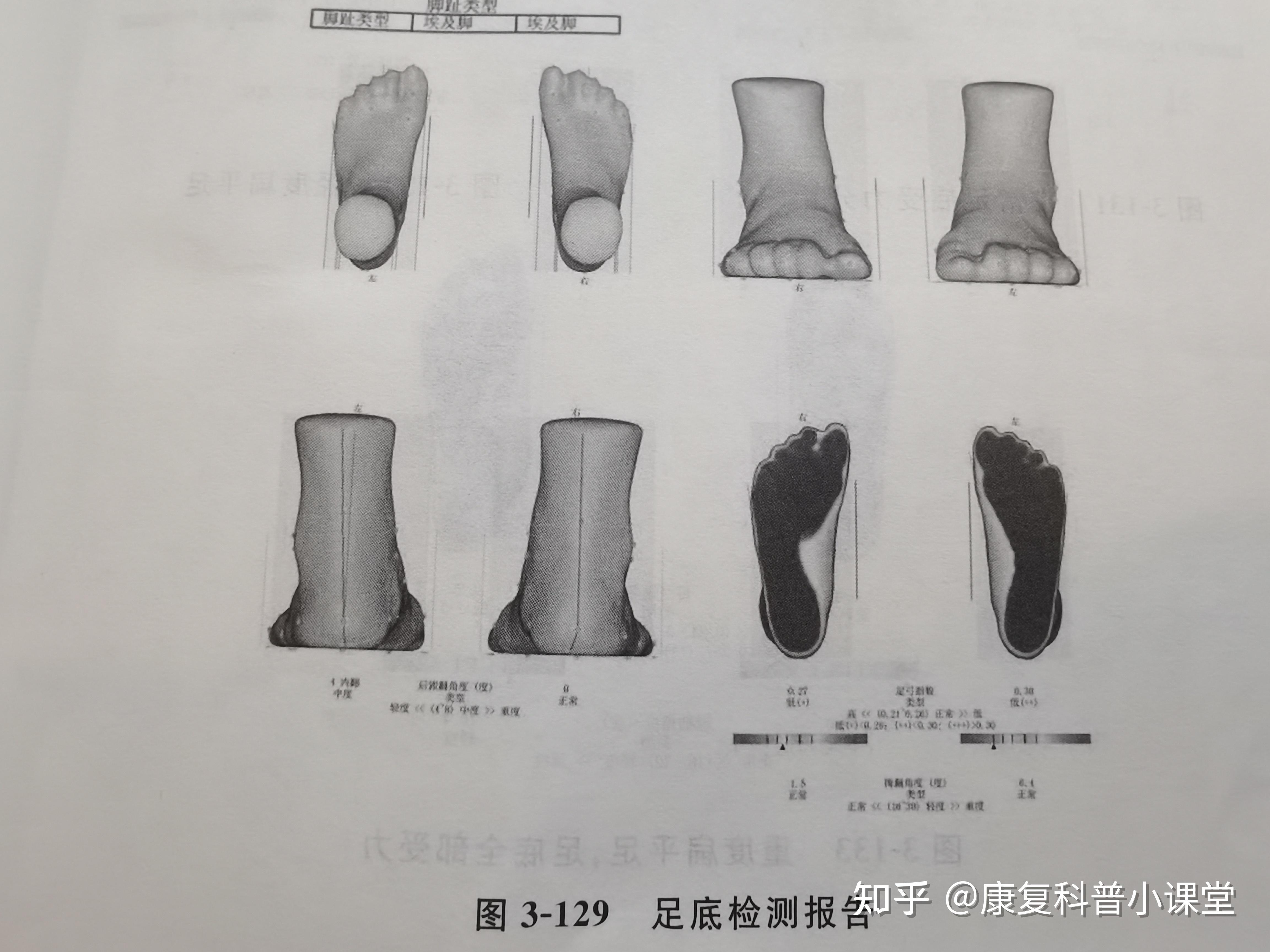 评估内容包括:足长,前脚掌宽,后跟宽,跗骨宽,跖骨围度,脚踝围度,跗骨