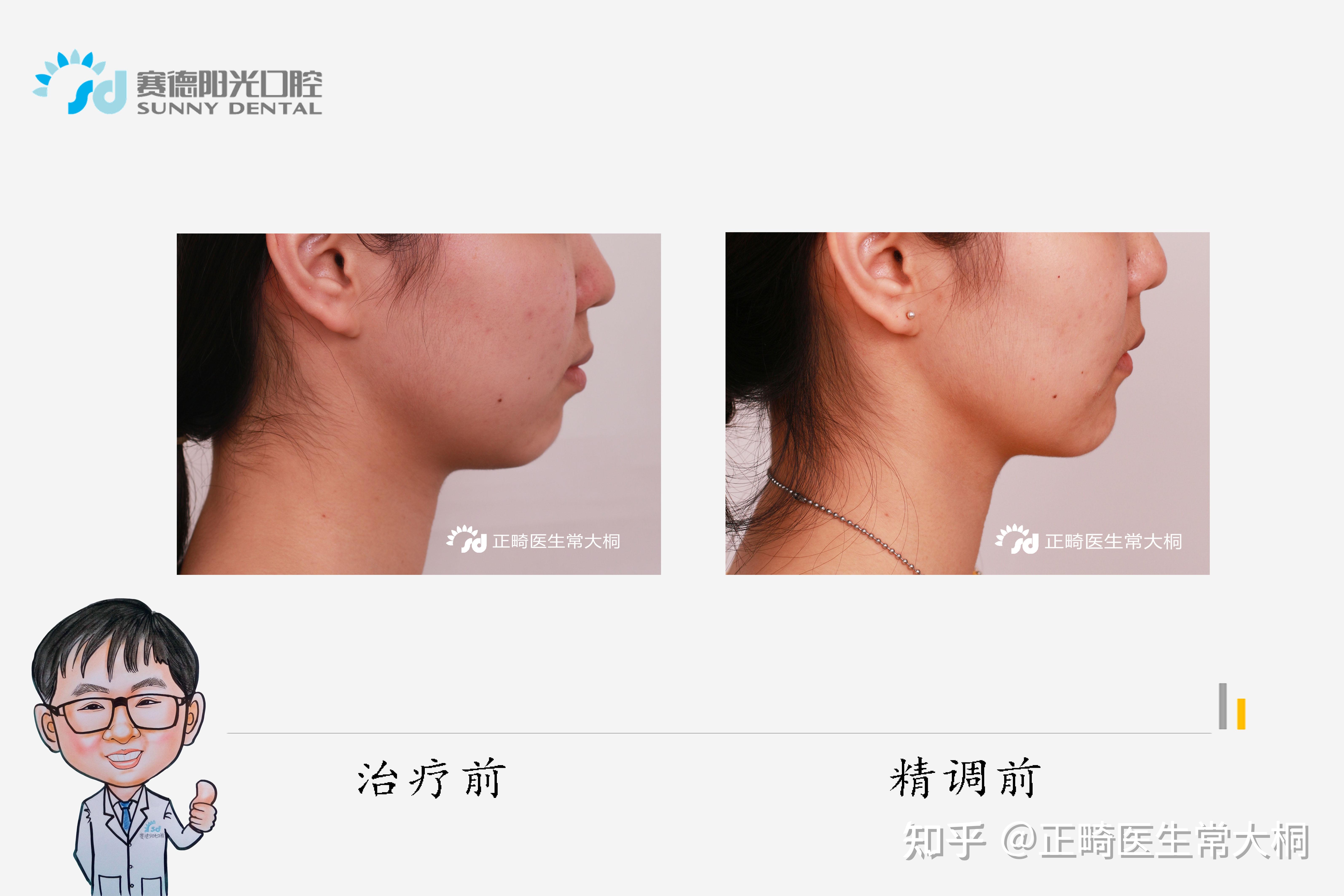 每周案例隐适美矫治器矫治嘴突下颌后缩