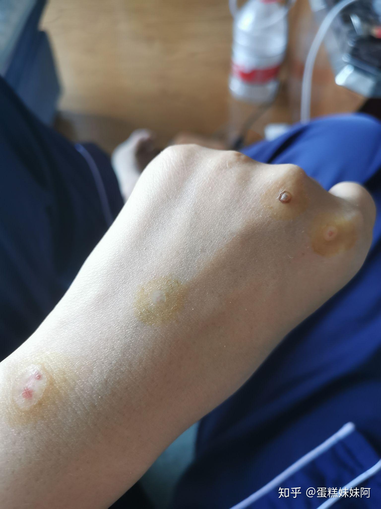 扁平疣|记录我做冷冻的这段时间 - 知乎