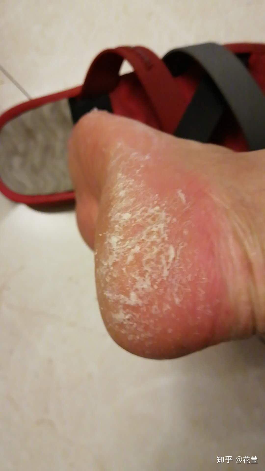 多年的脚气怎么治? - 知乎