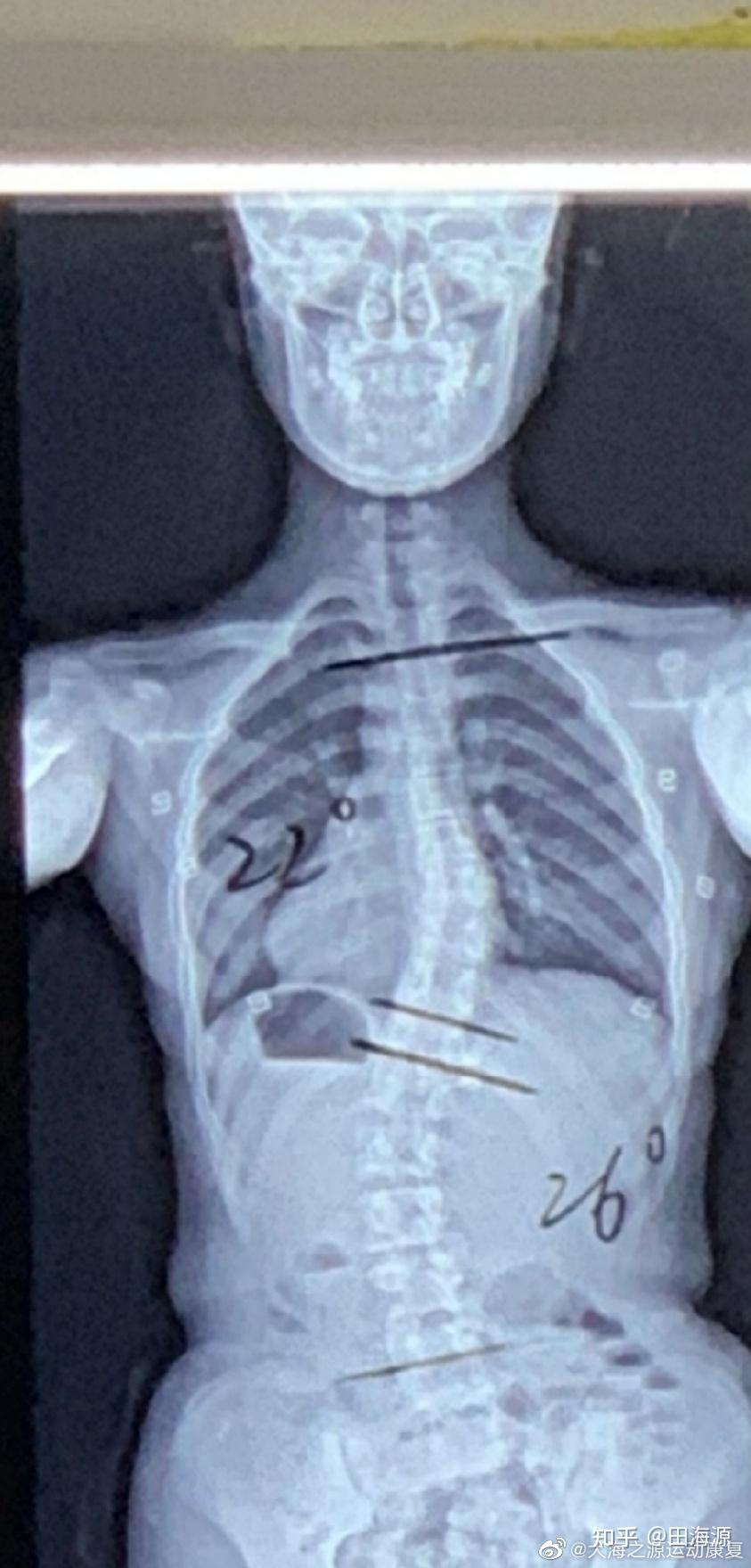 胸椎呈s状侧弯图片