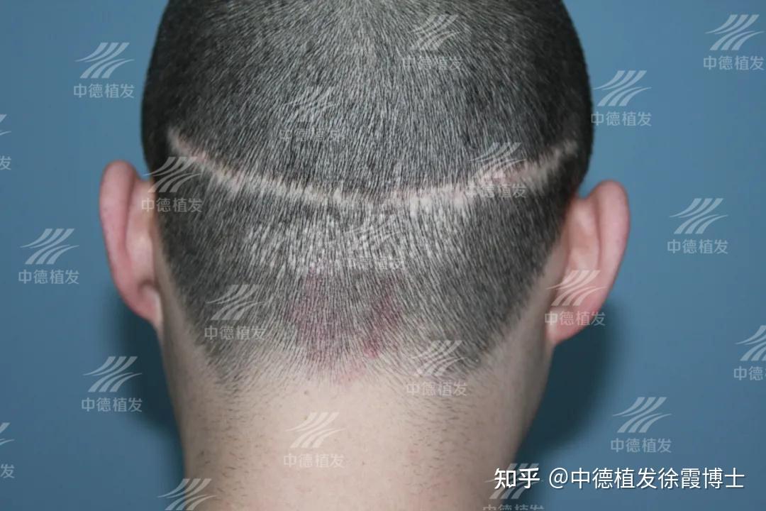 植发失败了怎么办？经典案例分析为您指明前路！ - 知乎