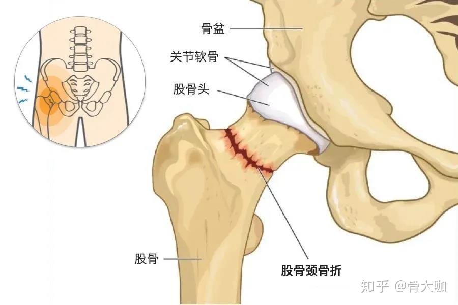 股骨干骨折位置图片图片