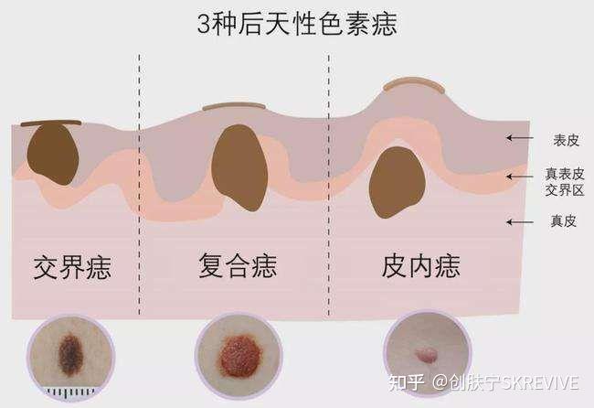 激光還是藥水?點痣之後用什麼好? - 知乎