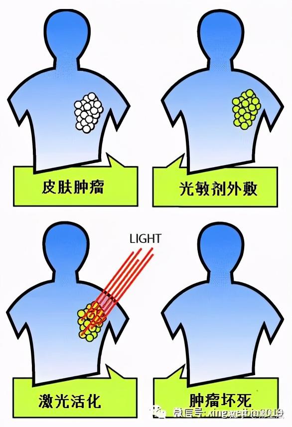 皮肤肿瘤无创诊疗新技术——光动力疗法 - 知乎