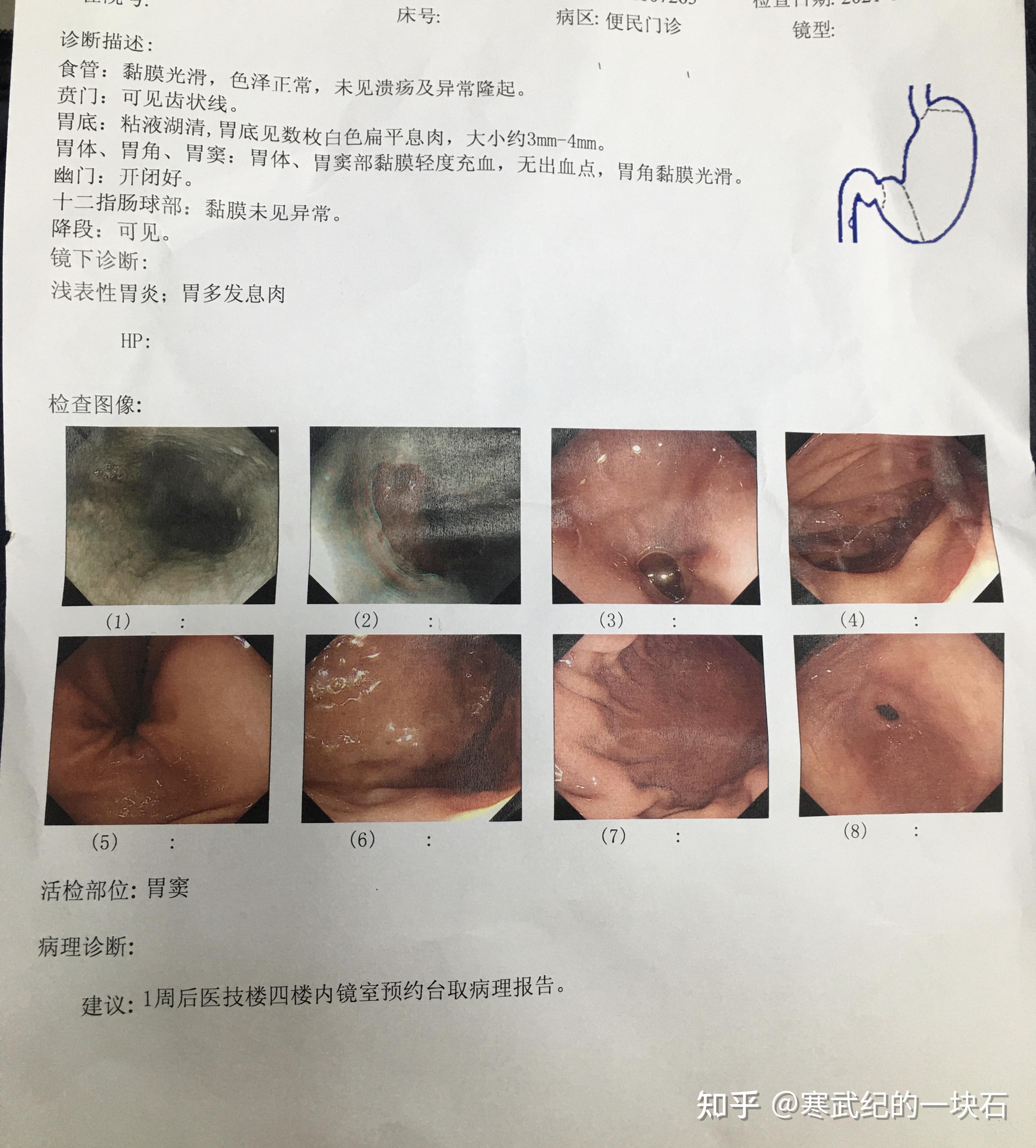 胃镜检查需要多久图片