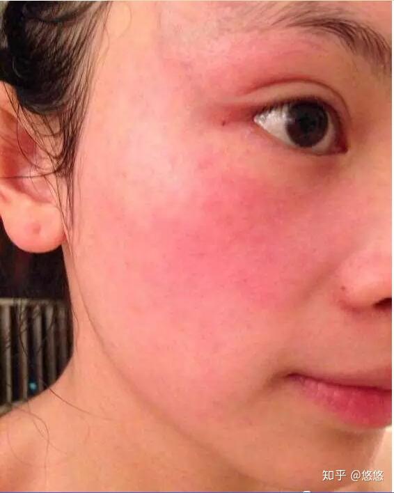 皮肤屏障受损脸颊时不时泛红,发痒,长红疹该怎么修复