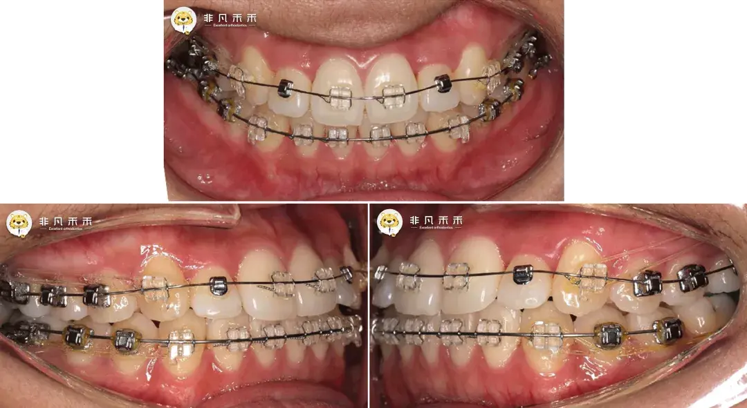 正畸病例牙擁擠不齊骨性Ⅲ類不拔牙矯治病例1例