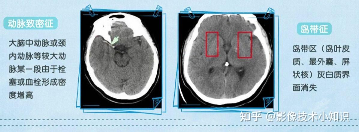脑梗死影像学表现图片
