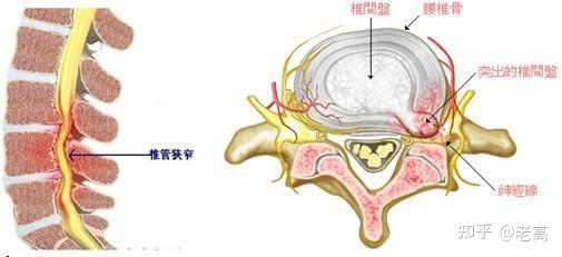 椎间孔大小图片