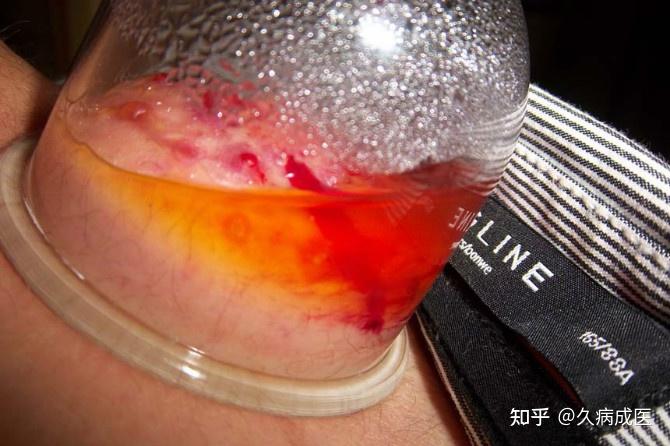 十多二十年前玻璃罐头瓶很流行,普通人会采用燃烧纸条的方式抽空瓶子