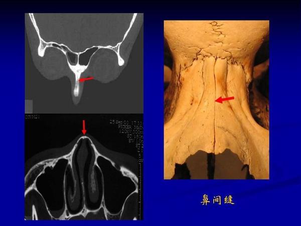 鼻骨解剖及CT诊断-供法医鉴定参考 - 知乎